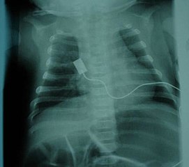 X-ray cho thấy thân hình chuông do teo cơ liên sườn và sử dụng cơ bụng để thở. Thân hình chuông không cụ thể đối với những người mắc bệnh SMA