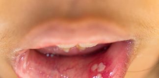 Hình ảnh HPV trong miệng