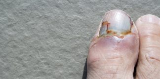 Một ngón chân cái có móng bị gãy