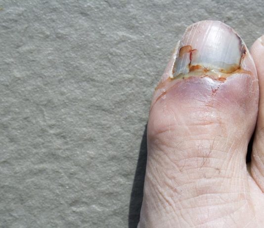 Một ngón chân cái có móng bị gãy